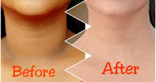 How To Get Rid Of Dark Neck In 15 Minutes Fast And Quickly Dark Skin Around Neck Skin Lightening Diy Lighten Skin