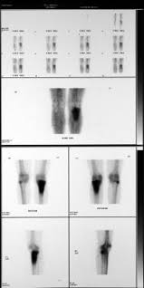 Image result for Osteomyelitis Bone Scan