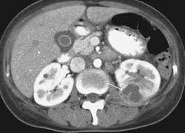 Dx Renal Abscess In A 67 Year Old Woman A And B Contrastenhanced Ct Scans Show A Low Attenuated Nonenhancing Lesion Arrow In Ct Scan Renal Radiology