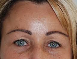 Ulrike keller aus leipzig die augenbrauen weg. Augenbrauentransplantation Kostenlose Informationen Und Beratung Zu Augenbrauentransplantation Hairforlife