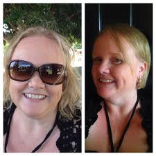 Living with weightloss surgery