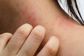 A psoríase leve em placas pode ser tratada com emolientes, queratolíticos, alcatrão, corticoides tópicos, análogos de vitamina d3, somente antralina ou combinados. Campanha De Conscientizacao Sobre A Psoriase Revista Visao Hospitalar