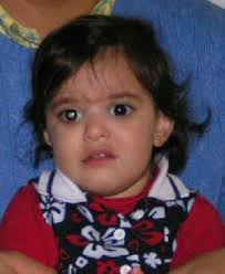 Diseases usually are indicated by signs and symptoms. Signs And Symptoms Of Retinoblastoma We C Hope