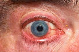 Image result for Ciliary Flush