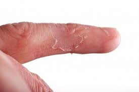 Image result for Hand Infection
