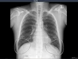 Conclusion of living anatomy of the chest congratulations! Vuno Publishes Study Of Its Ai Powered Solution Improving Chest X Ray Reading Accuracy Mobihealthnews