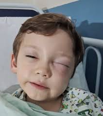 Menino de 6 anos de SP é picado no rosto por aranha-marrom, que pode ser  fatal; saiba o que fazer