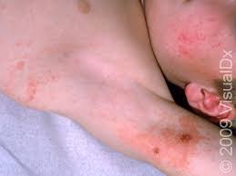Image result for dermatitis contacta children