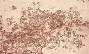 Amorphous Urate Crystal Medical Laboratory Scientist Medical Laboratory Crystals