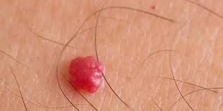 Cherry angiomas or hemangiomas are little, bright red, pinpoint to match head sized, flat spots that over time, become raised, more dome shaped and ac. Cherry Angioma Causes Symptoms Diagnosis Cherry Angioma Treatment