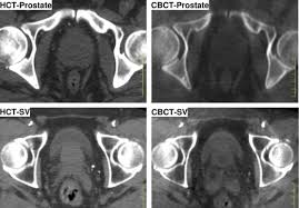Home/ disease prevention/what is oncology? Quantitative Evaluation Of Cone Beam Computed Tomography In Target Volume Definition For Offline Image Guided Radiation Therapy Of Prostate Cancer Radiotherapy And Oncology