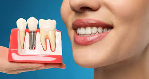 Advantages and Disadvantages of Dental Implant | Dentevim Dental Clinic