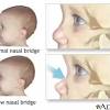 Epicanthal folds are defined as a condition in which skin of upper eyelid show skin folds towards inner corner of eye. Https Encrypted Tbn0 Gstatic Com Images Q Tbn And9gcrl O4i4xy4n3m6iwdwjxdmsnclme1ois6cr4vtrwqtxeidy Ke Usqp Cau