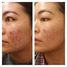 We did not find results for: Melano Cc 3 Week Difference Asianbeauty