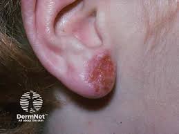 Image result for dermatitis contacta children