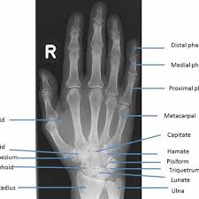We did not find results for: Standard Ap X Ray Of The Hand And Wrist With Labels Naming The Bones Download Scientific Diagram