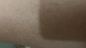 Image result for svrab na k%u016F%u017Ei