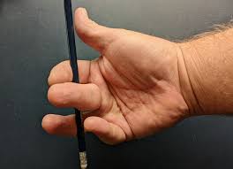 Image result for Elson Extensor Tendon Test