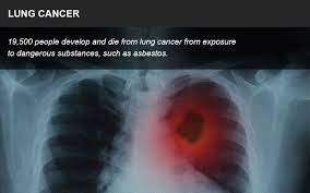 Check spelling or type a new query. Lung Cancer Asbestos Lawyer Mesothelioma Impact Law