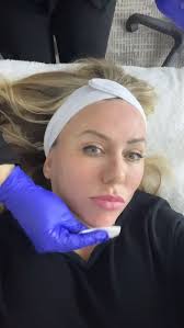 Chemical Peel time! @dermalogicapro now at @rface_medspa with  @cainelainegrace #smooth skin #atlchemicalpeels #eastcobb