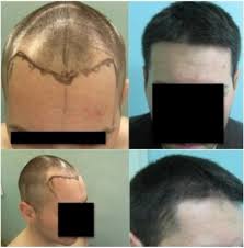 Based on our years of experience, we say that the best and most sustainable results will be achieved when we transplant. Finding The Best Fue Hair Transplant Doctor In The World Dermhair Clinic