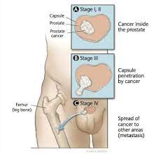 Cancer that has spread is more likely to generate more complications than when it is still at its early stage. Cancer Cell Leakage