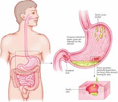 Gambar 6.11 lambung dibagi menjadi tiga bagian, kardiak, fundus, dan pilorus. Memahami Secara Detail Tentang Infeksi Penyakit Pada Lambung Cakapsehat Com