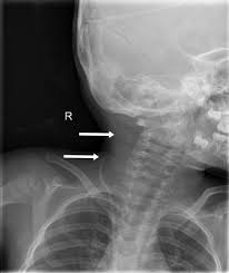 Emdocs Net Emergency Medicine Educationcomplications Of Csf Shunts Ed Presentations Evaluation And Management Emdocs Net Emergency Medicine Education