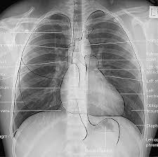 Normal Chest X Ray Cxr Labelled Normal Chest X Ray Cxr Systematic Approach To Frontal Chest X Ray How To Read A Chest X X Ray Medical Knowledge Xray Tech