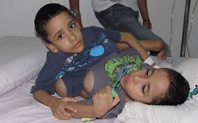 They were joined at the head and died immediately after their complicated surgical separation. 10 Interessante Geschichten Von Siamesischen Zwillingen