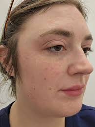 What could be causing swelling, itching, and burning sensations in  fibromyalgia patients?