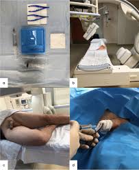 Image result for Retrograde Urethrogram