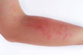 Image result for Atopic Dermatitis