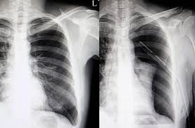 Image result for Pneumothorax