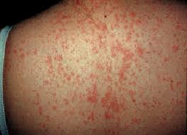 Joanna harp, a dermatologist at weill cornell medicine in new york, told abc news. Measles Clinical Manifestations Diagnosis Treatment And Prevention Uptodate
