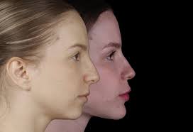 Este caso mostra como a cirurgia ortognática pode promover mudanças  funcionais e estéticas relevantes. Houve melhora importante no contorno  facial, na projeção do mento e na harmonia do nariz, com redução do