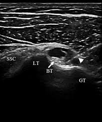 Image result for Biceps Tendon Injection