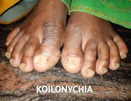 Image result for Koilonychia feet