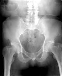 Urethral Stone And Urinary Squamous Cell Carcinoma Radiology Case Radiopaedia Org Squamous Cell Carcinoma Squamous Cell Stone