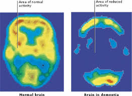 Check spelling or type a new query. An Illustration Image Of Brain Activity In Dementia 37 Download Scientific Diagram
