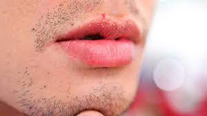 Jika kulit bibir memiliki ruam, menyerupai semolina atau butiran kecil dengan ukuran tidak lebih dari 3 mm, maka pasti itu adalah penyakit.itu tidak mewakili bahaya dan tidak mempengaruhi tubuh secara keseluruhan. Inilah Penyebab Bintik Putih Di Bibir Dan Cara Mengatasinya