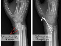 I Broke My Wrist Now What Joseph J Schreiber Md