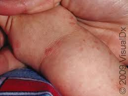 Image result for scabies human children