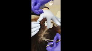 A scalp biopsy is a procedure that involves the removal of a small portion of the scalp from the patient's head. Scalp Biopsy Dy Dermatology Center