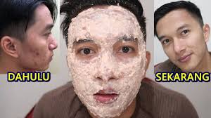 Just ambil putih telurnya sahaja. Terampuh Menghilangkan Jerawat Dan Bekasnya Lakukan Cara Ini Youtube