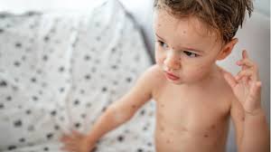 Når en smittet person hoster eller nyser, spres et sekret fra la barnet gå i lite, luftige eller ingen klær inne. Vannkopper Baby Babyverden No