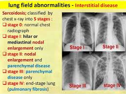 Lung Field Abnormalities Interstitial Disease Sarcoidosis Classified By Chest X Ray Into X Ray Human Anatomy And Physiology Idiopathic Pulmonary Fibrosis