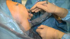 Ein kreuzbandriss ist eine gefürchtete und auch häufige knieverletzung. Nach Dem Riss Kreuzband Operation In Der St Vinzenz Klinik In Pfronten Youtube