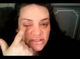 Resin Allergic Reaction Be Aware Youtube