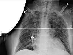 Guaranteed energy resolution ev fwhm. Pictorial Review Of Digital Radiography Artifacts Radiographics